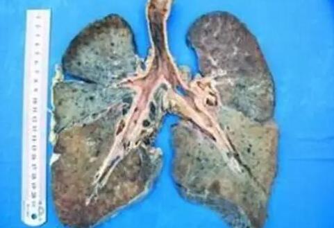 煙塵肺病——焊接樱桃小视频在线看